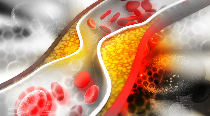 Novi marker za predvidevanje razvoja srčno-žilnih bolezni - Oksidiran LDL